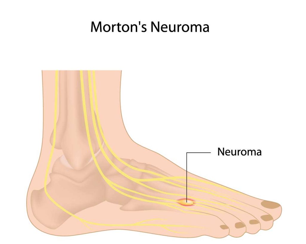 Neuromas in Yorville and Morris, IL