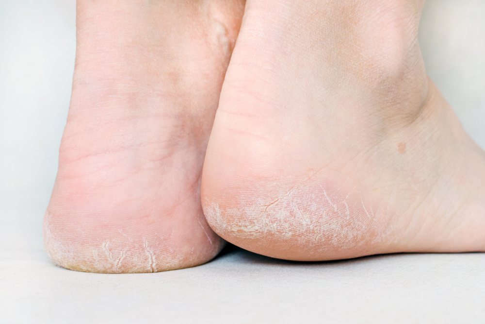 Calluses in Yorville and Morris, IL