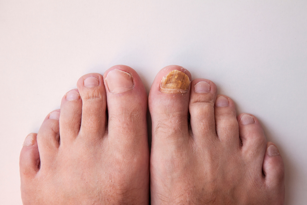 Toenail Fungus in Yorville and Morris, IL